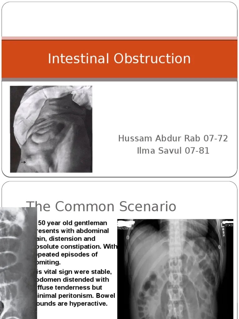 Intestinal Obstruction | PDF