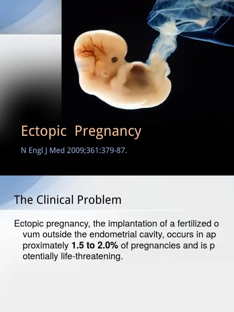 Ultrasonography Plays A Key Role In The Diagnosis And Management Of Ectopic Pregnancy Through ...