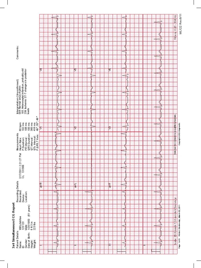 ECG Sample Report (1) | Electrocardiography | Cardiology