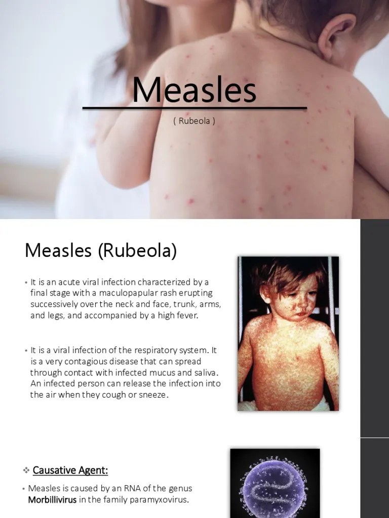 Measles (Case Presentation) | PDF | Measles | Infection