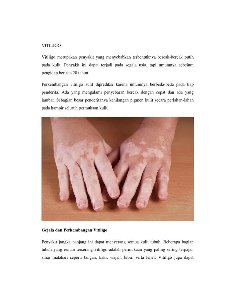Vitiligo | PDF