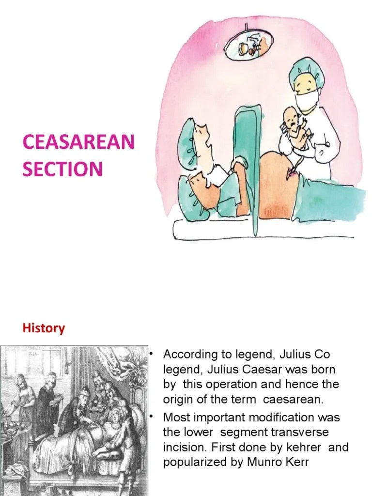 A Comprehensive Overview Of Cesarean Section: Indications, Techniques, And Postoperative Care ...