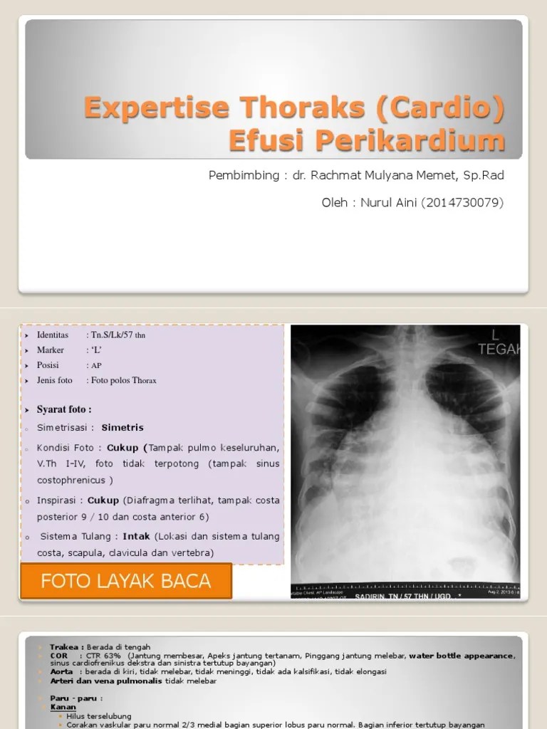 Efusi Perikardium - Aini | PDF