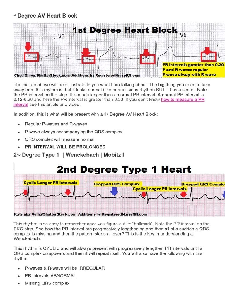 Heart Blocks | PDF | Cardiovascular Diseases | Electrophysiology