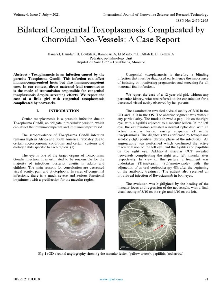 Bilateral Congenital Toxoplasmosis Complicated By Choroidal Neo-Vessels ...
