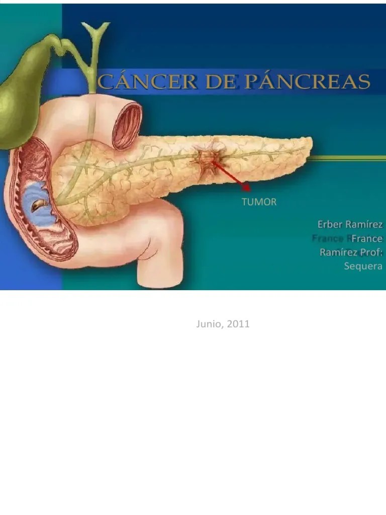 PDF Cancer De Pancreas | PDF