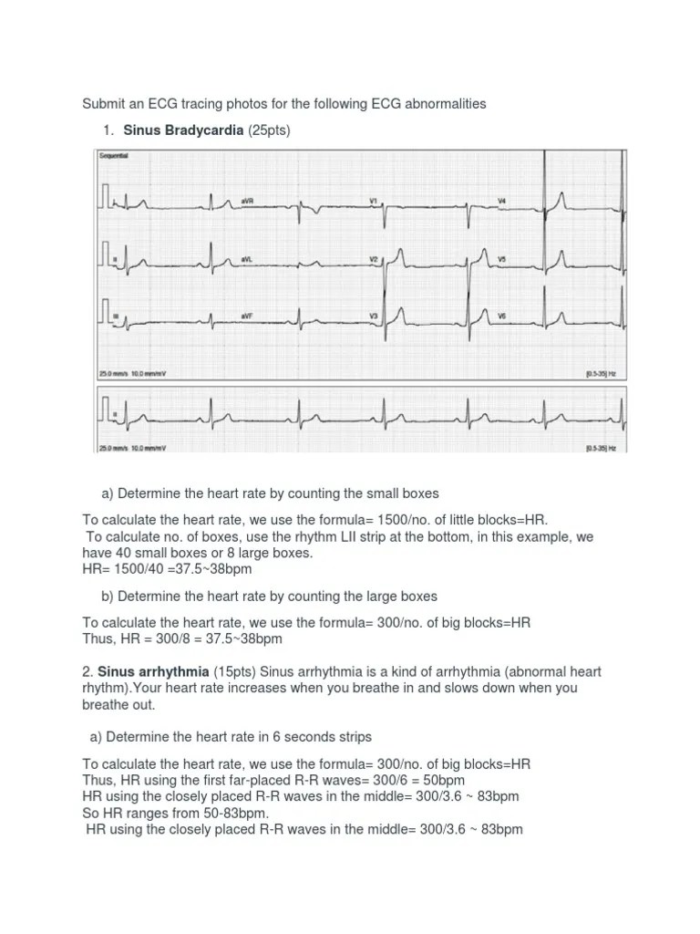 ECG Interpretation | PDF | Electrocardiography | Ventricle (Heart)