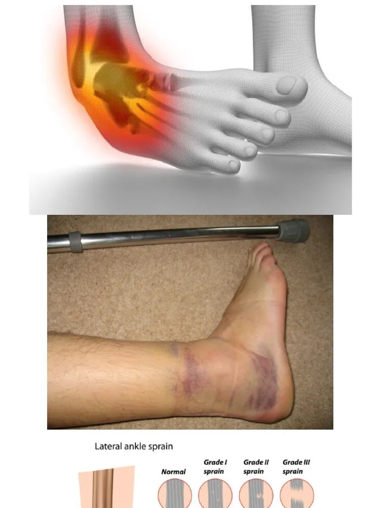 Ankle Sprain | PDF