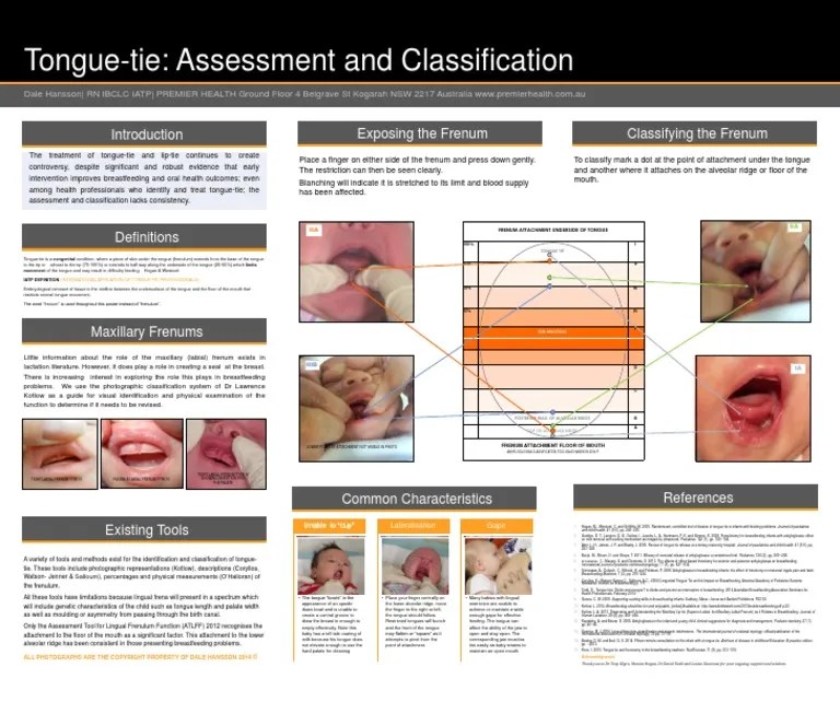 Tongue Tie - Classification - Poster - 2014 Premier Health | PDF ...