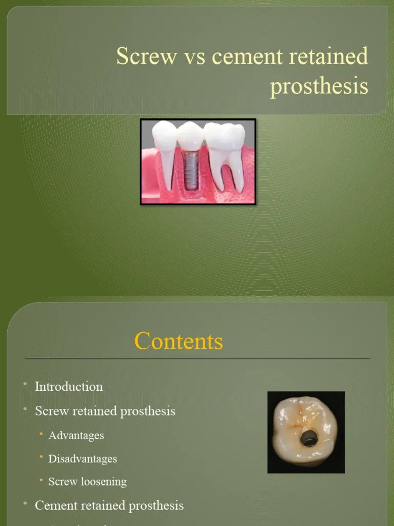 Screw Retained Vs Cement Retained Prosthesis | PDF | Dental Implant | Prosthesis
