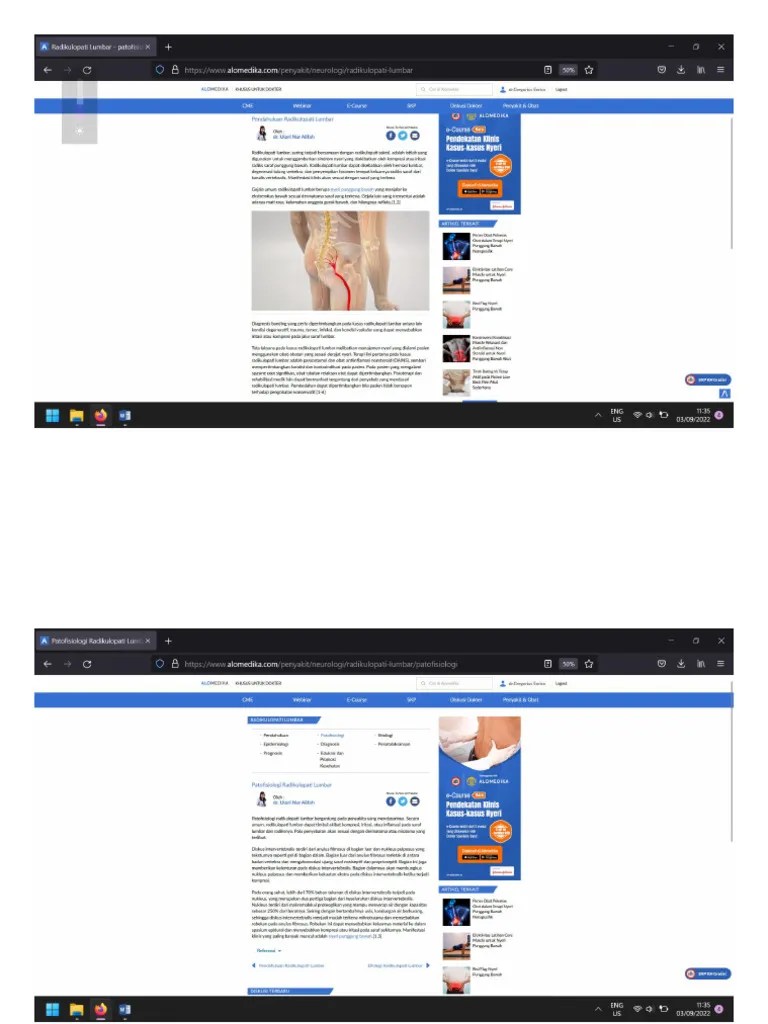 Radikulopati Lumbal | PDF