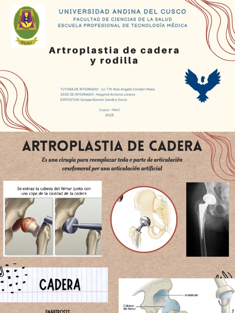 ARTROPLASTIA DE CADERA Y RODILLa | PDF | Rodilla | Anatomía Humana
