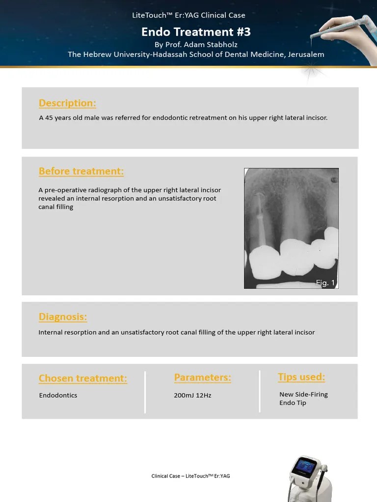 Endo-Treatment-3-with-LiteTouch™-Er-YAG-dental-laser | PDF