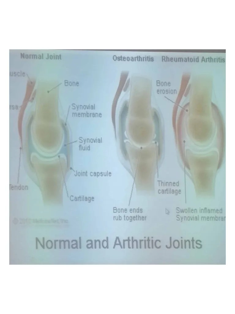 Rheumatoid Arthritis N Gout Pdf