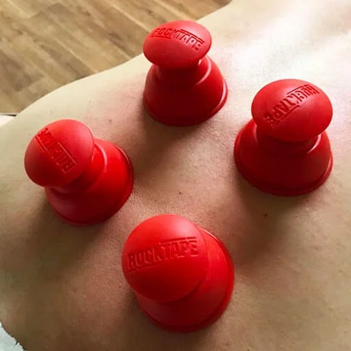 Cupping therapy cups on patient's back