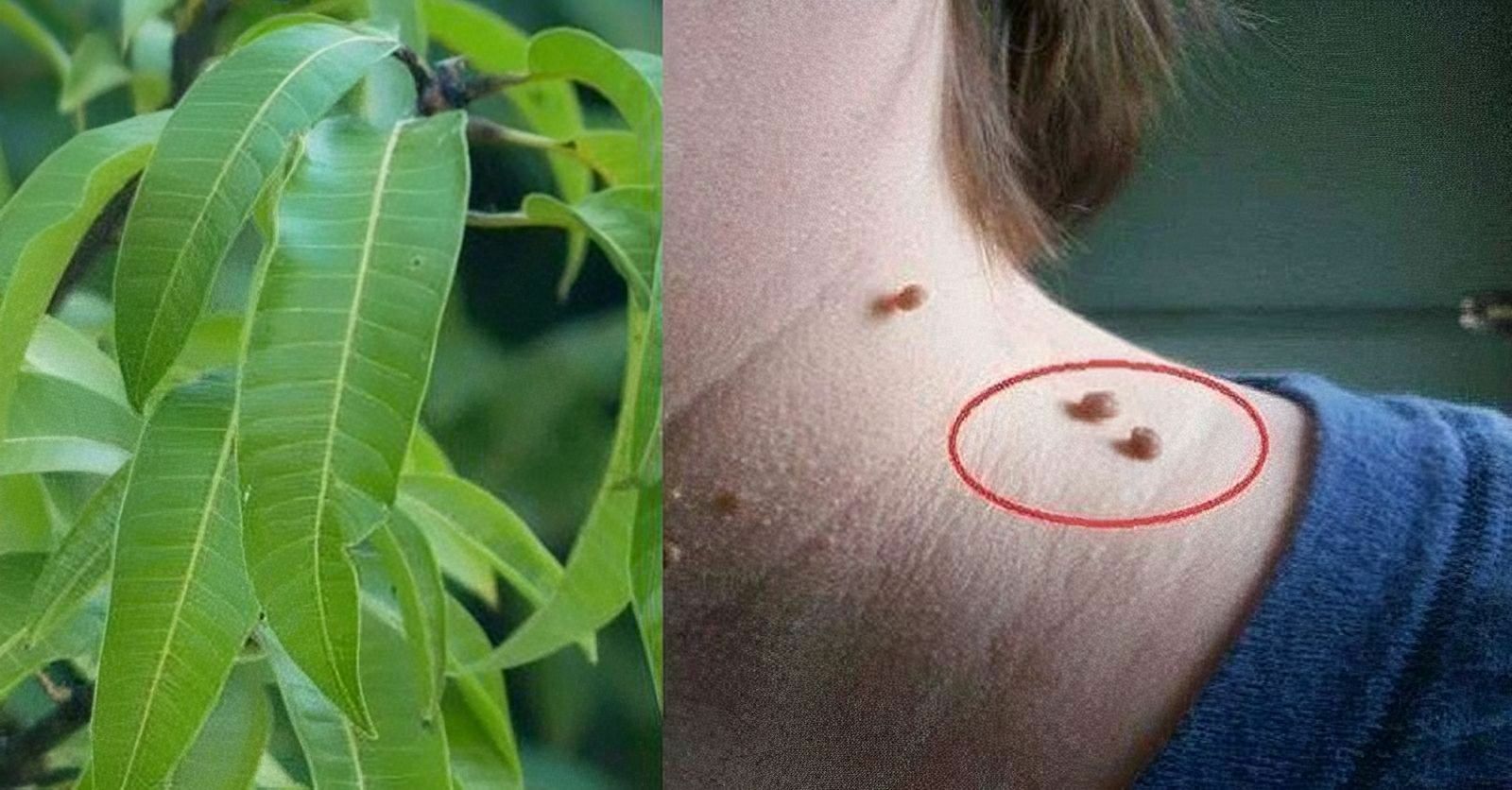 আঁচিল থেকে চিরতরে মুক্তি দেবে কচি আমপাতা!