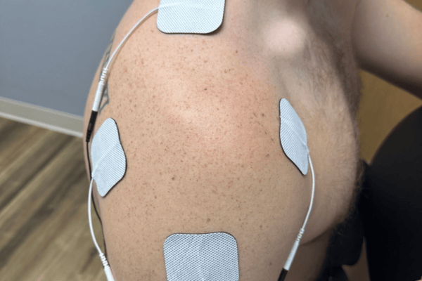 Shoulder Stim Pad Placement