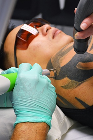 7 Most Frequently Asked Questions From Tattoo Removal Patients