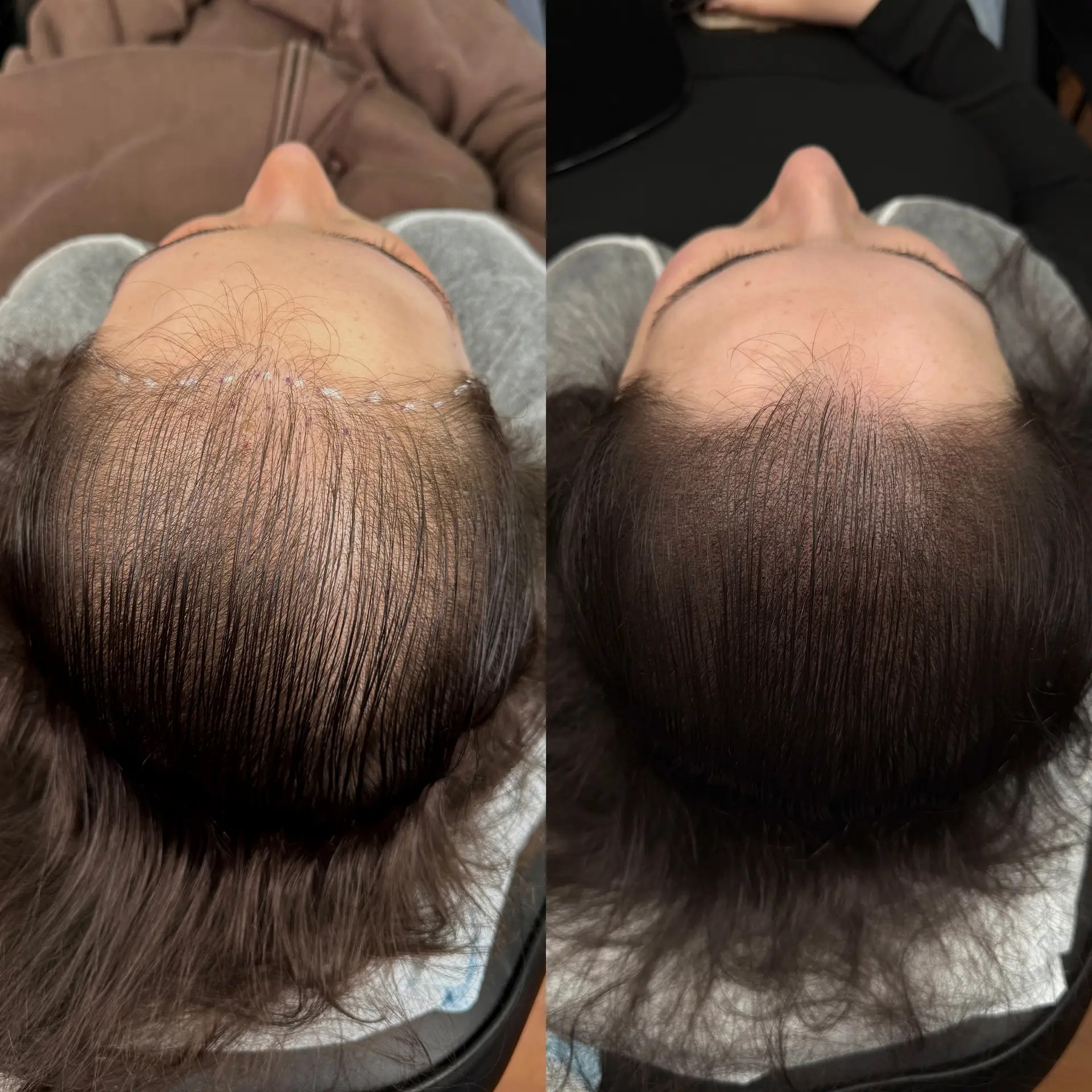 Inkling SMP Female Density for thinning hair