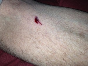 Ouchie.