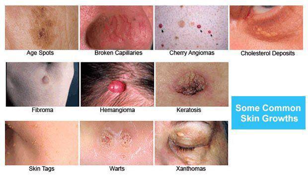 Common skin growths