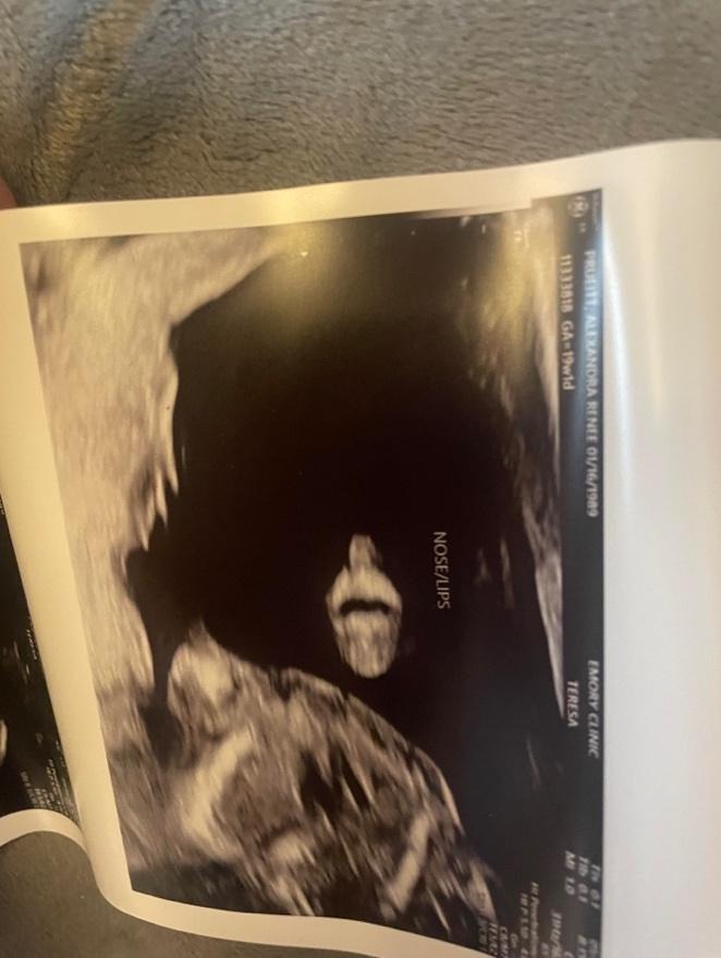 Ultrasound Prediction of Increased Risk of Sith’s Disease