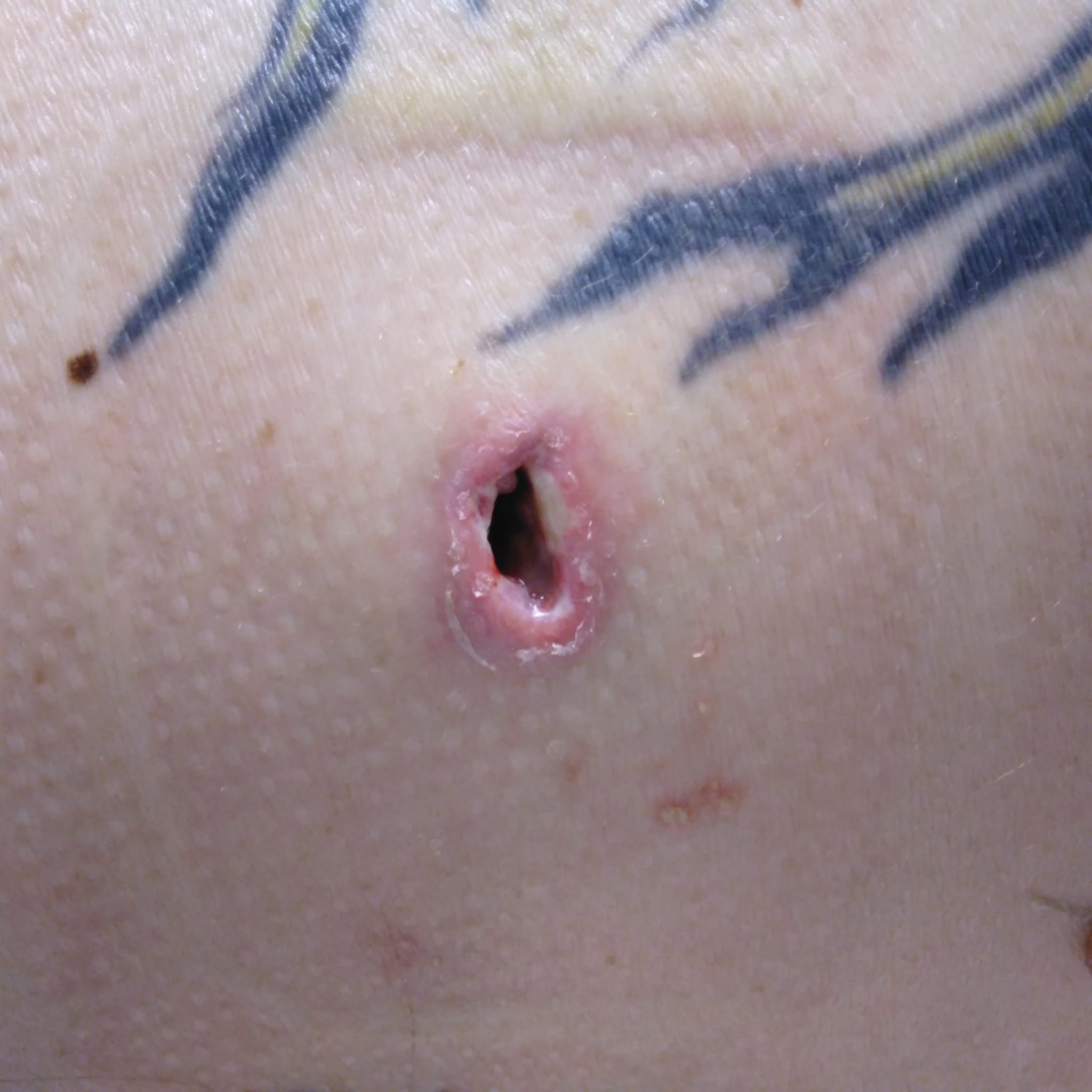 Bullet wounds (2) were from a .45 caliber bullet. (Courtesy)