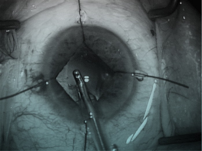 Why do I use iris stretching in cataract surgery? Jaheed Khan