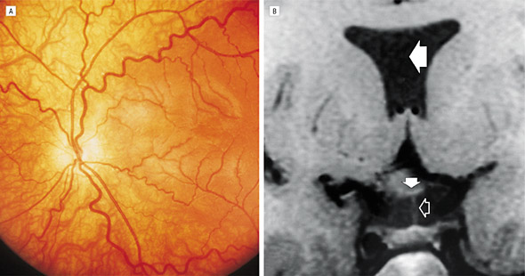 The left and right vertebral arteries and the left and right common . Optic Nerve Hypoplasia With Isolated Tortuosity of the