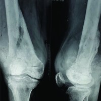 Effect of Combination Chemotherapy and Radiotherapy in the Management of a Pathological Fracture in High-grade Osteosarcoma with Limb Salvage Procedure – A Case Report