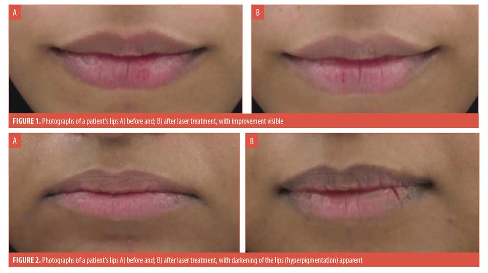 Burstein, md, phd, talks to webmd's chief medical editor about breakthroughs and future prospects for improved detection and treatment of breast, ovarian, uterine, and cervical cancers. Efficacy And Safety Of Q Switched Double Frequency 532 Nm Neodymium Doped Yttrium Aluminum Garnet Laser In The Treatment Of Lip Hyperpigmentation A Pilot Study Jcad The Journal Of Clinical And Aesthetic Dermatology