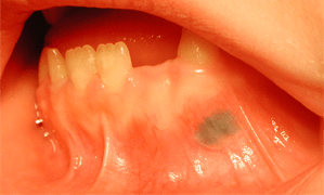 Un Rare Cas De Pigmentation De La Muqueuse Buccale Diagnostic Differentiel Et Presentation Du Cas Jcda