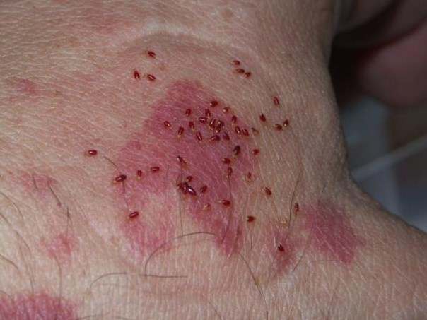 It's not easy, but you can get rid of them yourself by following these tips. The 4 Types Of Canadian Bedbugs Jdm Pest Control