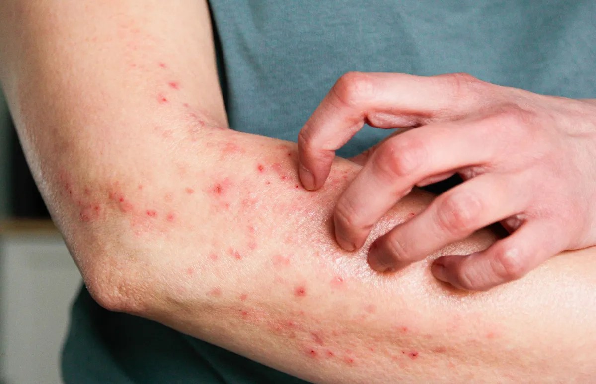Mpox