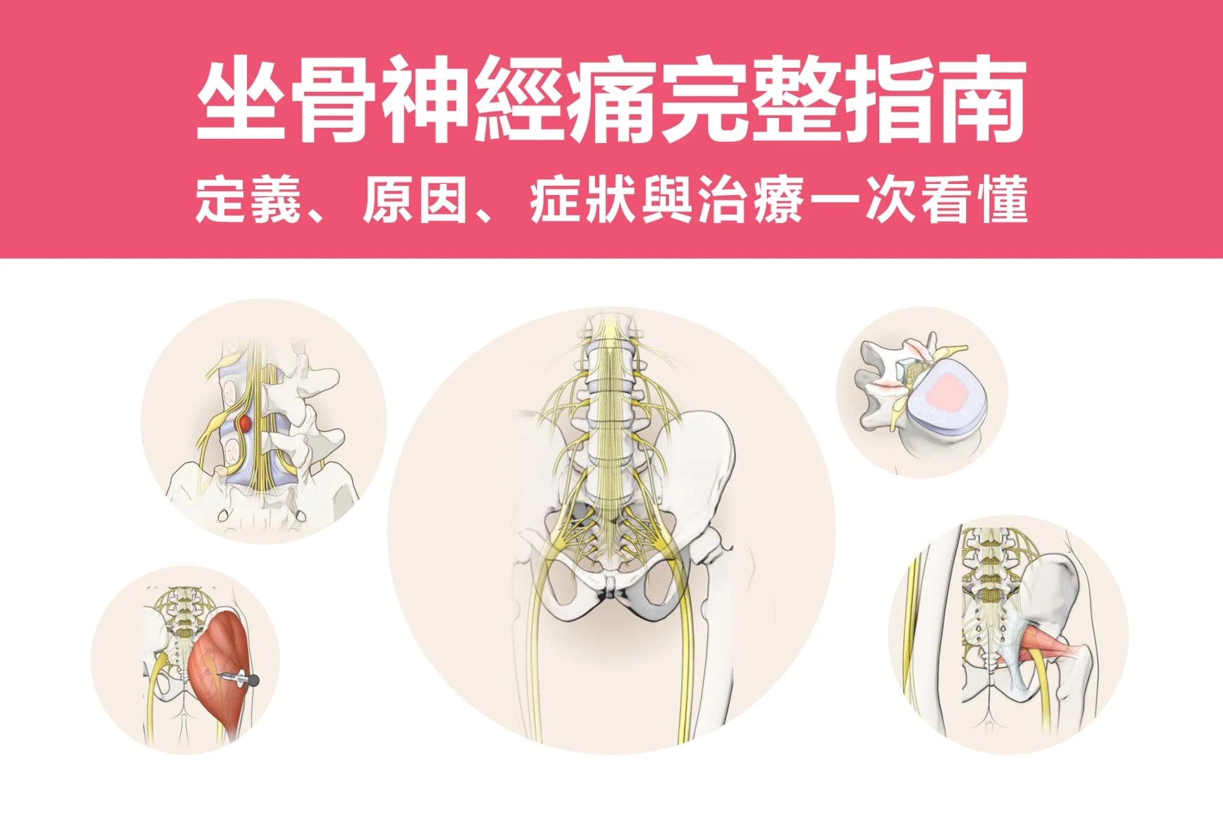 坐骨神經痛完整指南