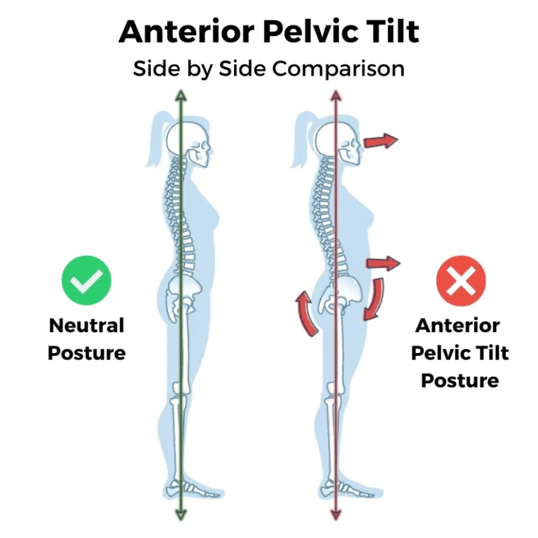 Illustration of normal posture vs. anterior pelvic tilt posture.