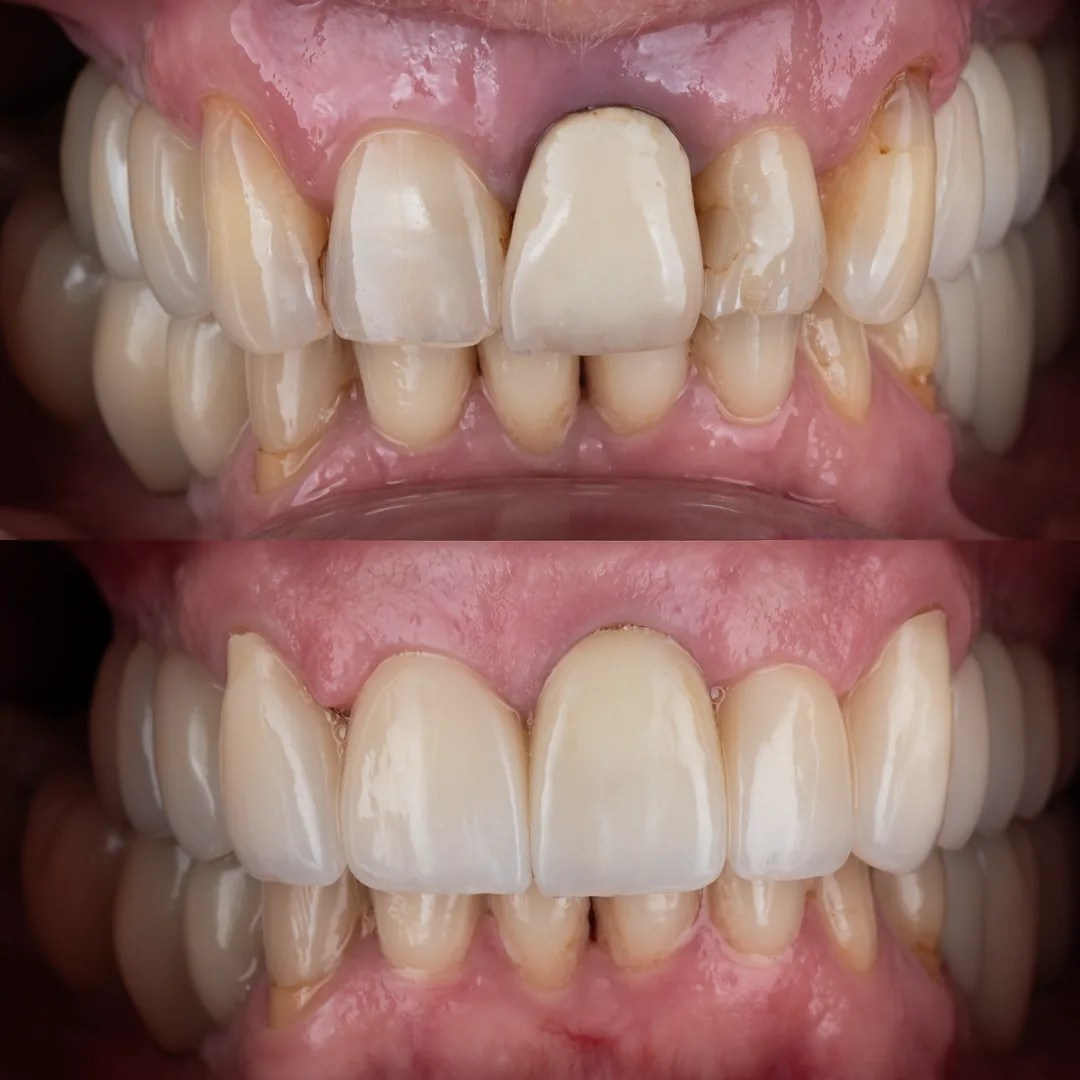 Dental implant with replacement crown for missing tooth