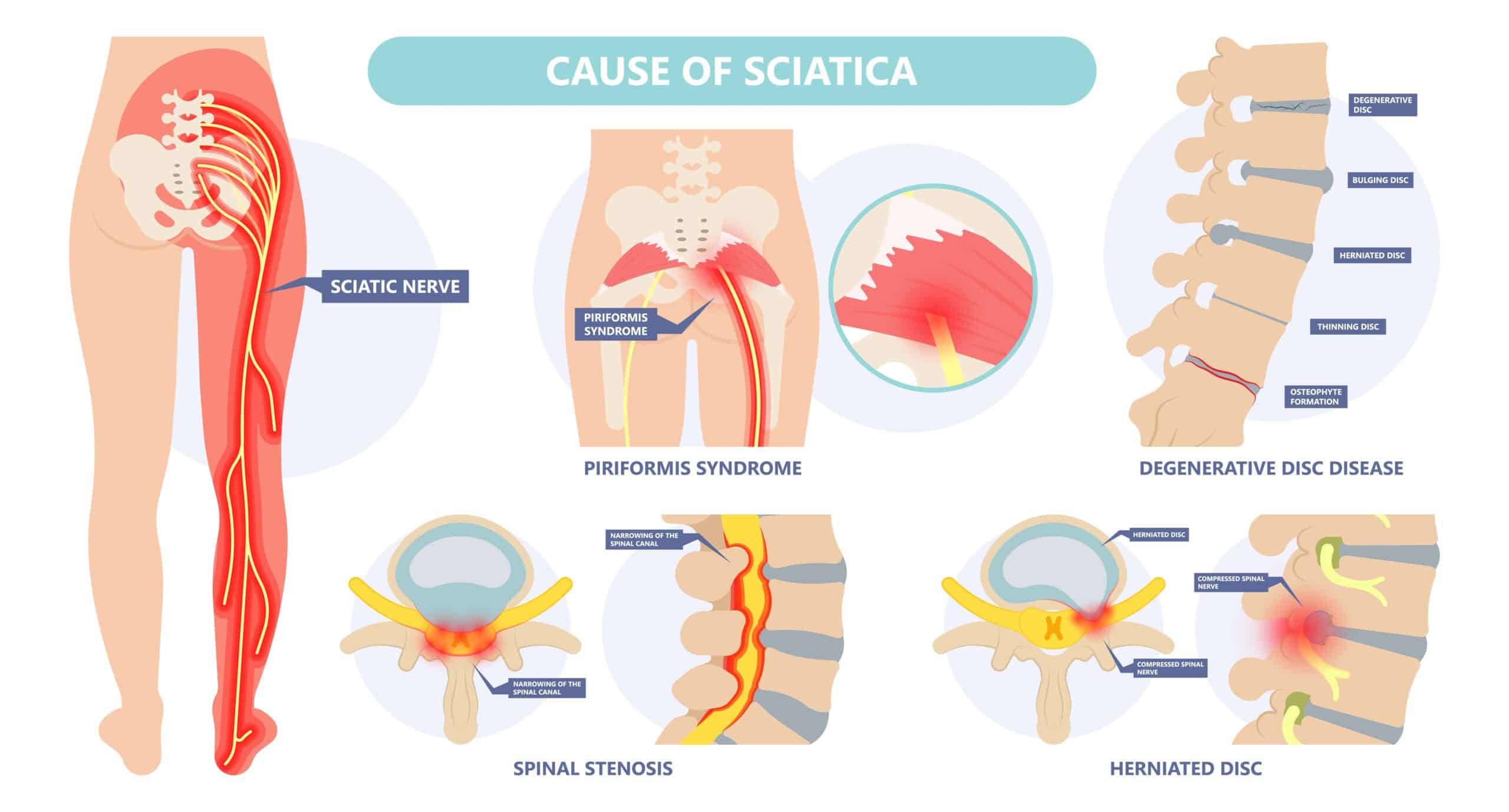 Sciatica symptoms in men