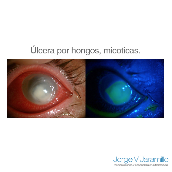 ulceras