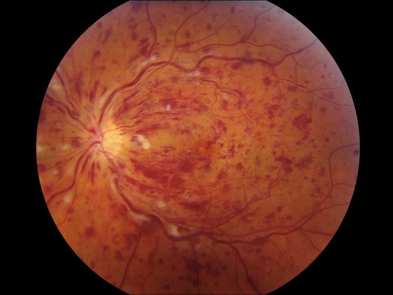 43+ Clever Blinding Eye Disease : Can blindness be spread by flies? - BugBitten / What do you do when you have a problem w.