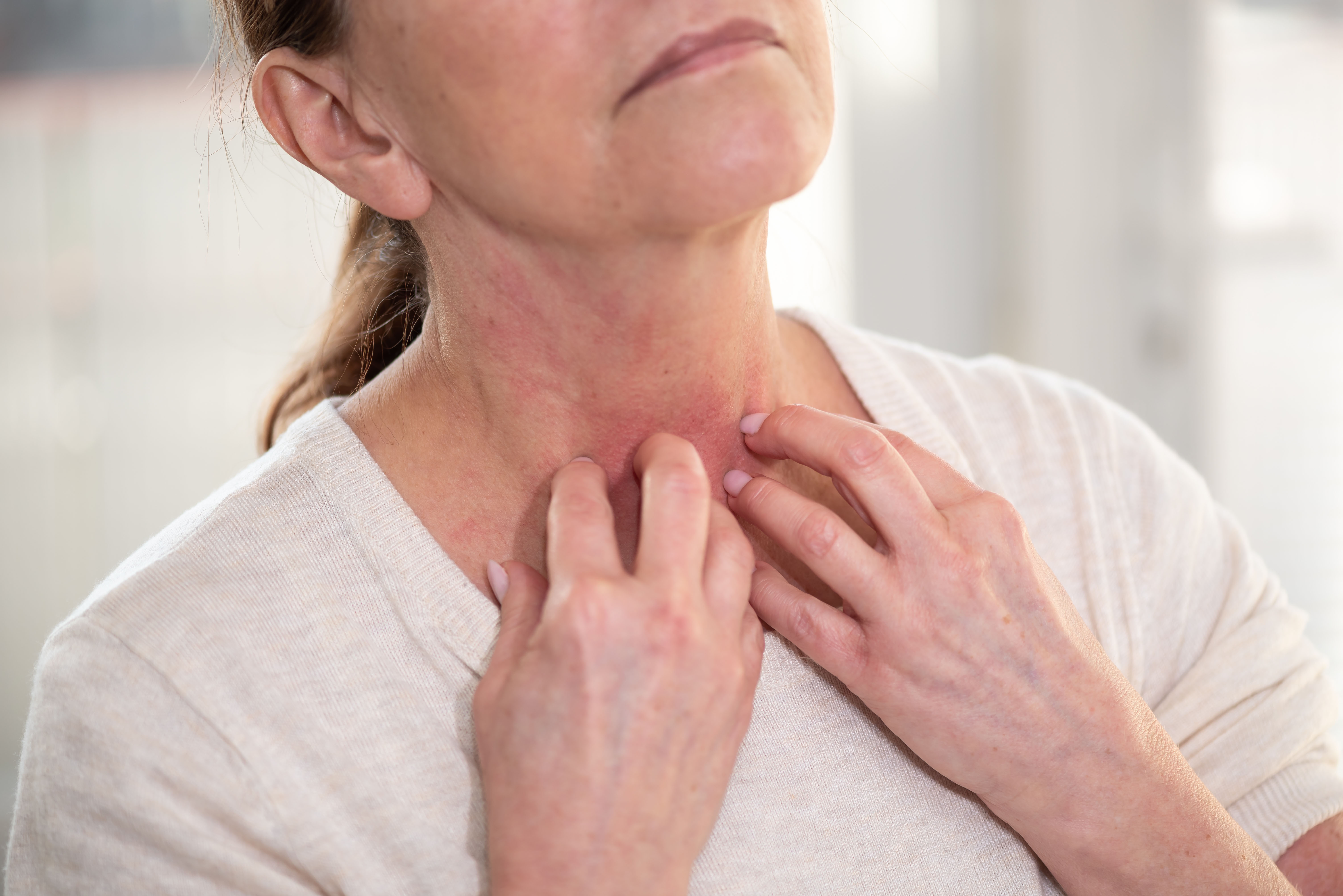 Dermatitis - jeukende huid en vrouw die in haar nek krabt. Allergiesymptomen