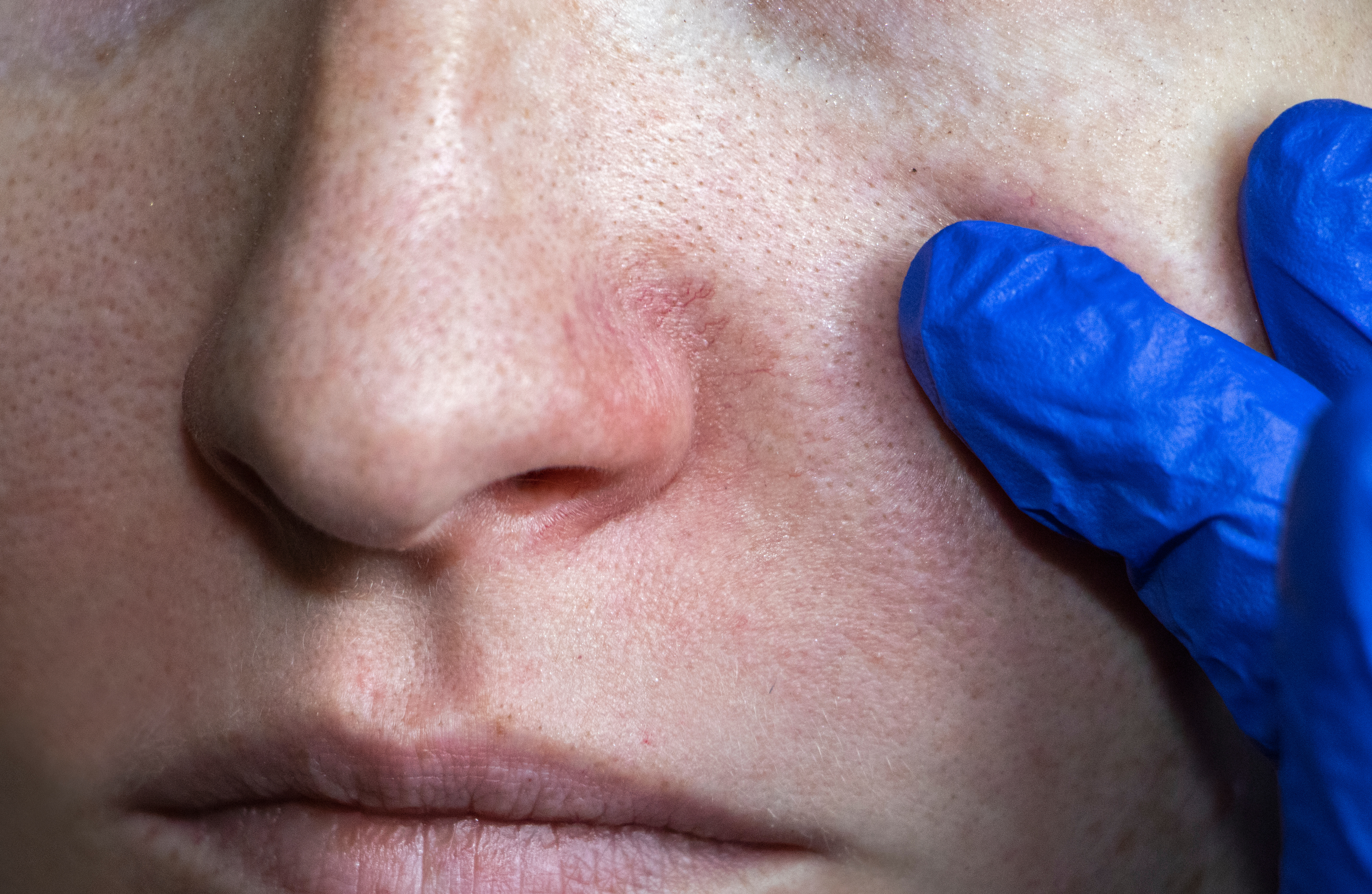 Rosacea - Junita Skincare