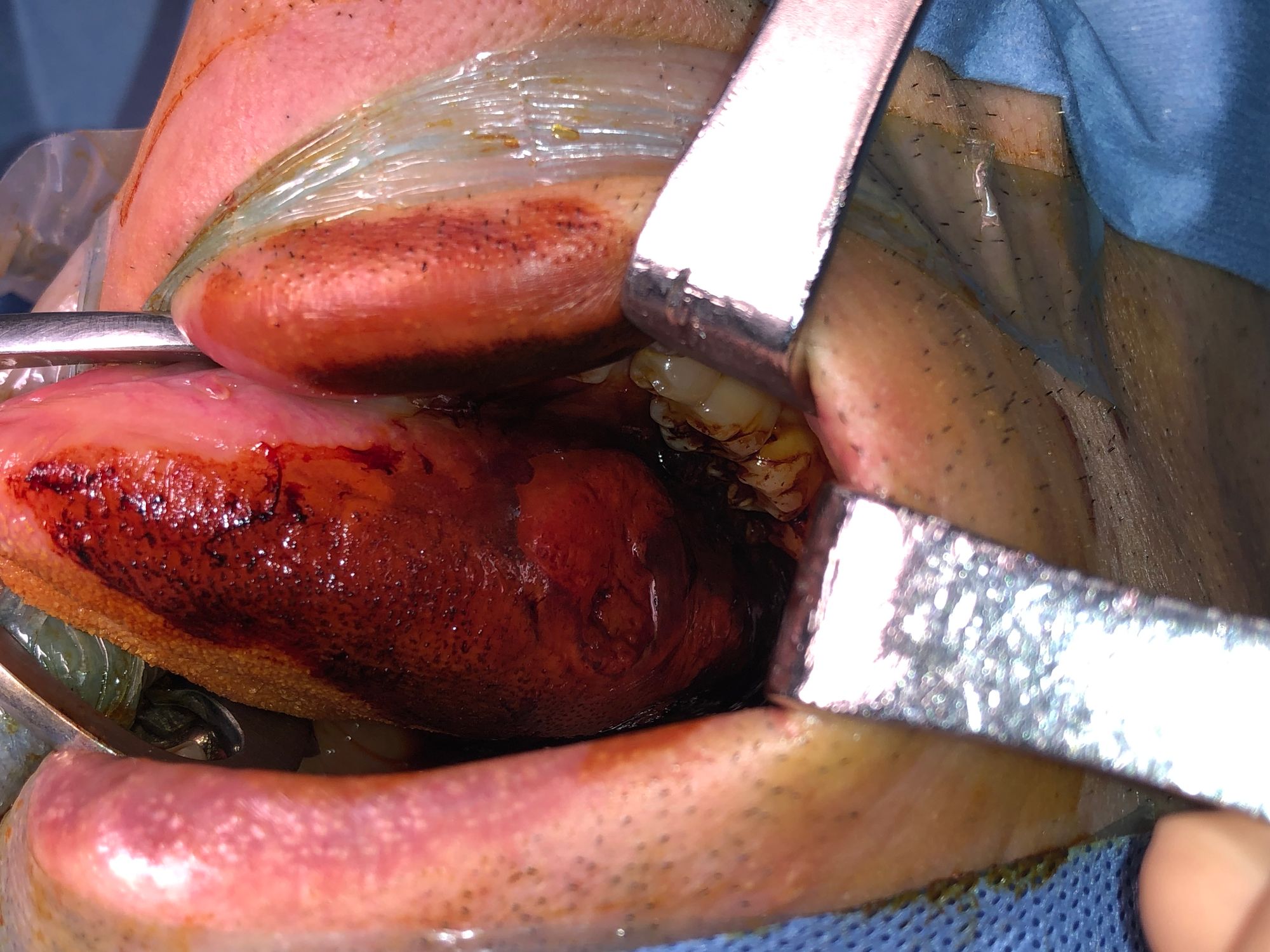 염색 후 병변의 경계