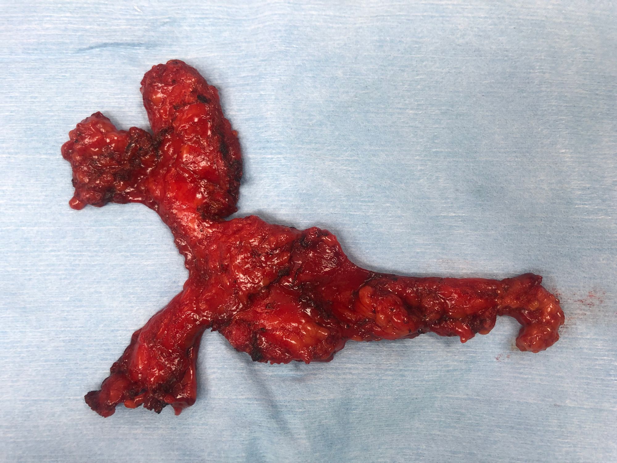 예방적 임파선 절제술