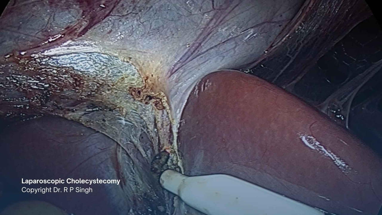 Best hospital for gall bladder surgery in gurgaon now offer clipless cholecystectomy