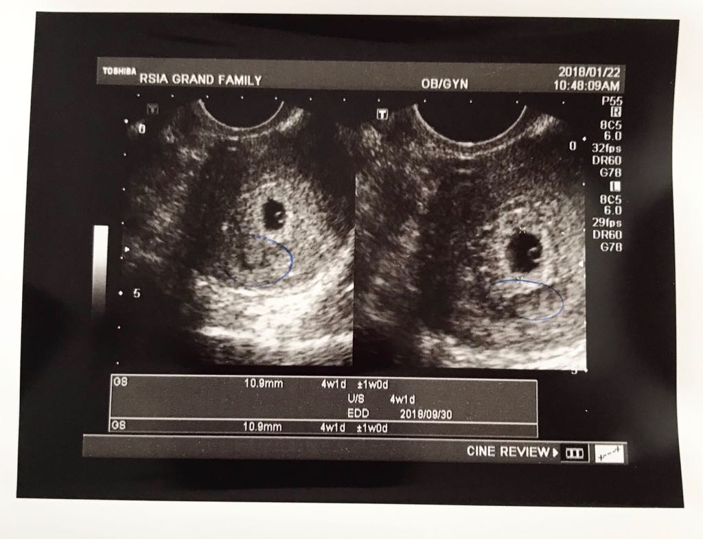 Tidak hanya itu, anda juga akan mengetahui jenis . Kehamilan Minggu Ke 4