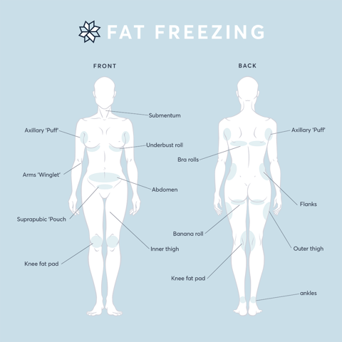 CoolSculpting