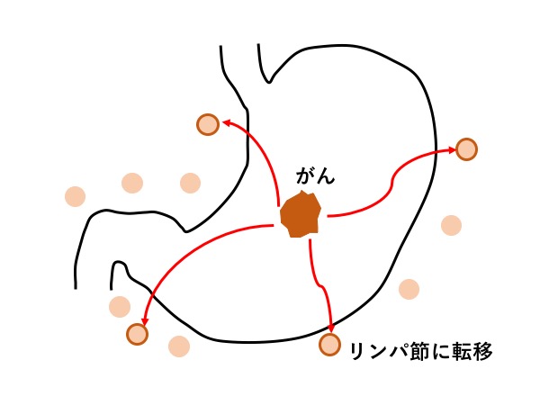 胃がんを手術せずに治す！内視鏡治療の利点と欠点を解説 | 外科医の視点