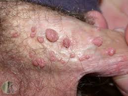 Fibroids are placed into one of four categories,. Cara Mudah Menghilangkan Kutil Tumor Fibroid Pengetahuan Kesehatan672