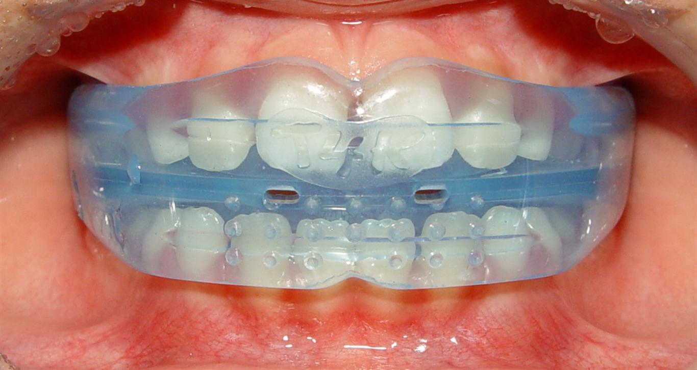 Lets talk about myofunctional orthodontics Kevin O'Brien's